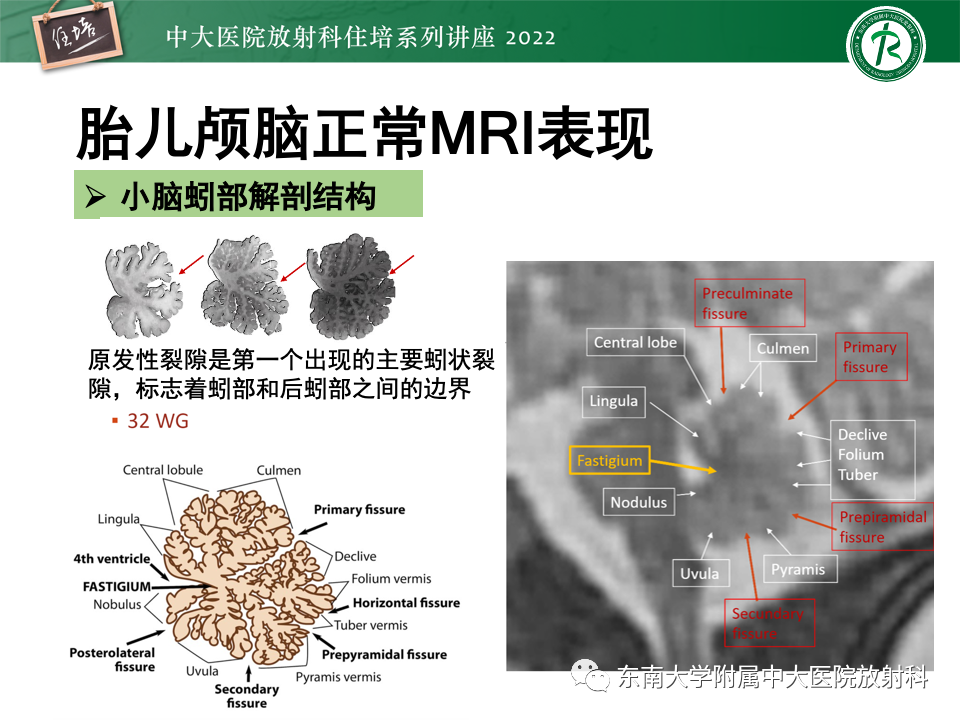 影像PPT - 【PPT】胎儿颅脑MRI技术及常见神经系统发育异常-22