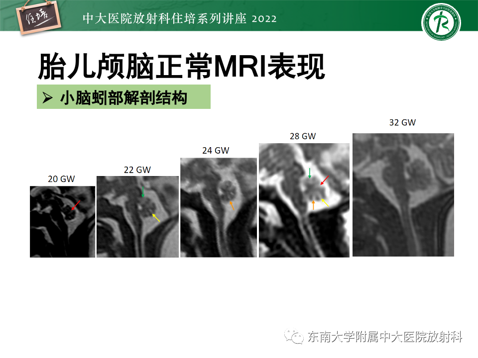 影像PPT - 【PPT】胎儿颅脑MRI技术及常见神经系统发育异常-23