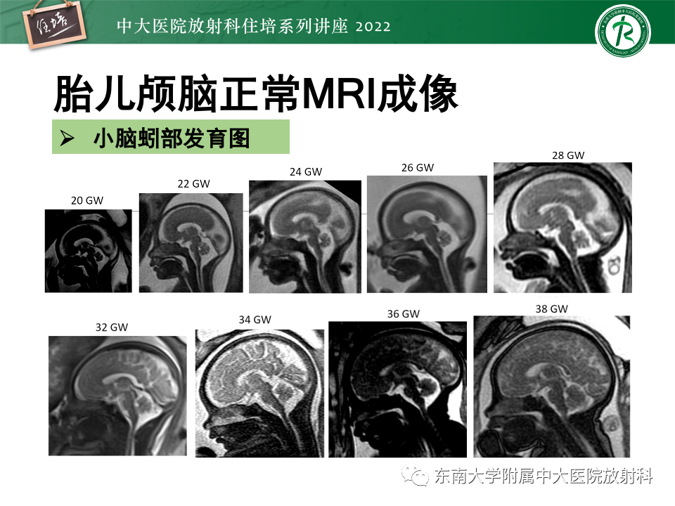 影像PPT - 【PPT】胎儿颅脑MRI技术及常见神经系统发育异常-24