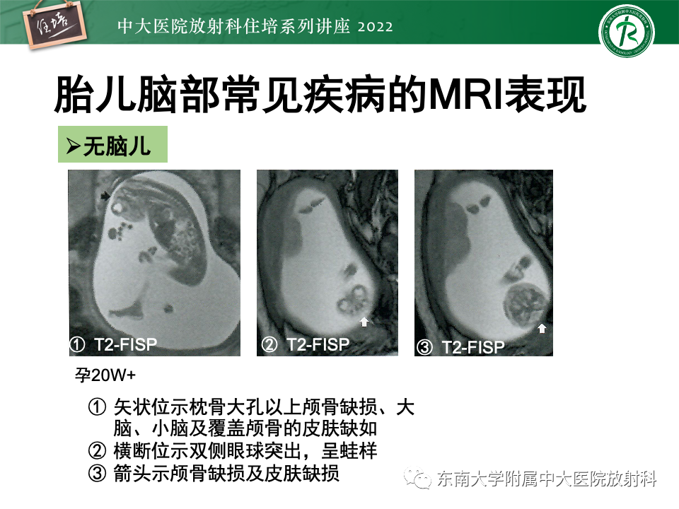 影像PPT - 【PPT】胎儿颅脑MRI技术及常见神经系统发育异常-28