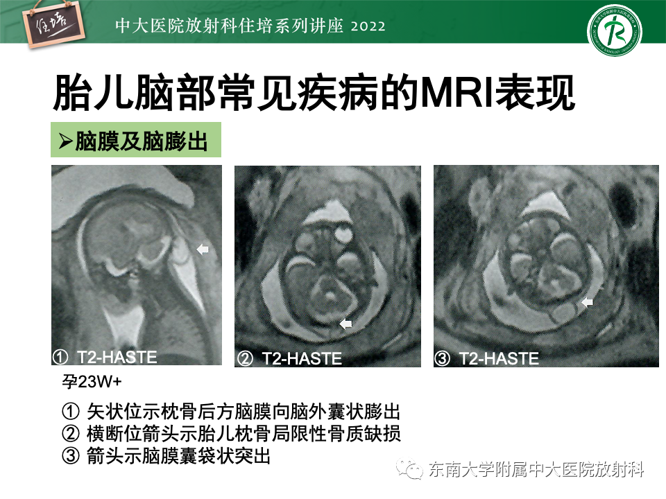 影像PPT - 【PPT】胎儿颅脑MRI技术及常见神经系统发育异常-30
