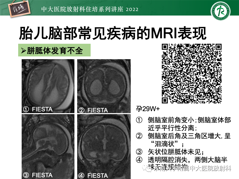 影像PPT - 【PPT】胎儿颅脑MRI技术及常见神经系统发育异常-34