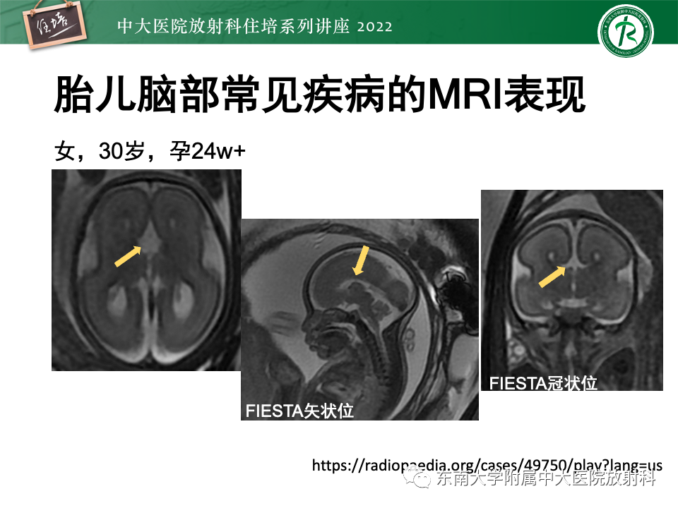 影像PPT - 【PPT】胎儿颅脑MRI技术及常见神经系统发育异常-35