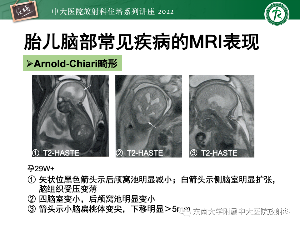 影像PPT - 【PPT】胎儿颅脑MRI技术及常见神经系统发育异常-37