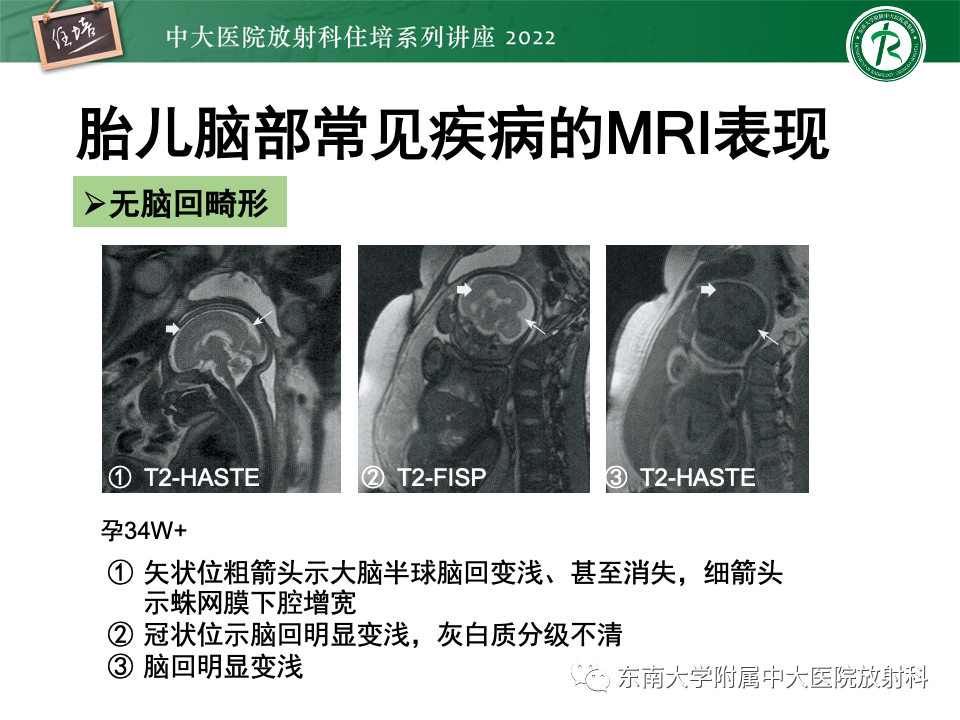 影像PPT - 【PPT】胎儿颅脑MRI技术及常见神经系统发育异常-40