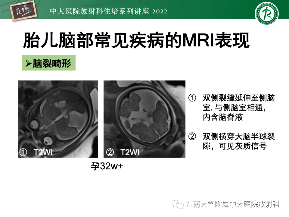 影像PPT - 【PPT】胎儿颅脑MRI技术及常见神经系统发育异常-42