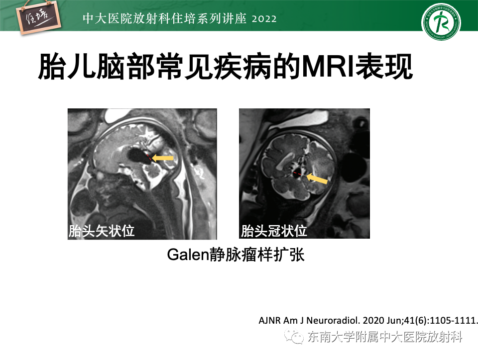 影像PPT - 【PPT】胎儿颅脑MRI技术及常见神经系统发育异常-47