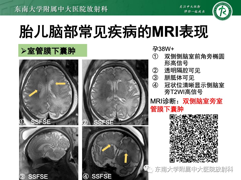 影像PPT - 【PPT】胎儿颅脑MRI技术及常见神经系统发育异常-49