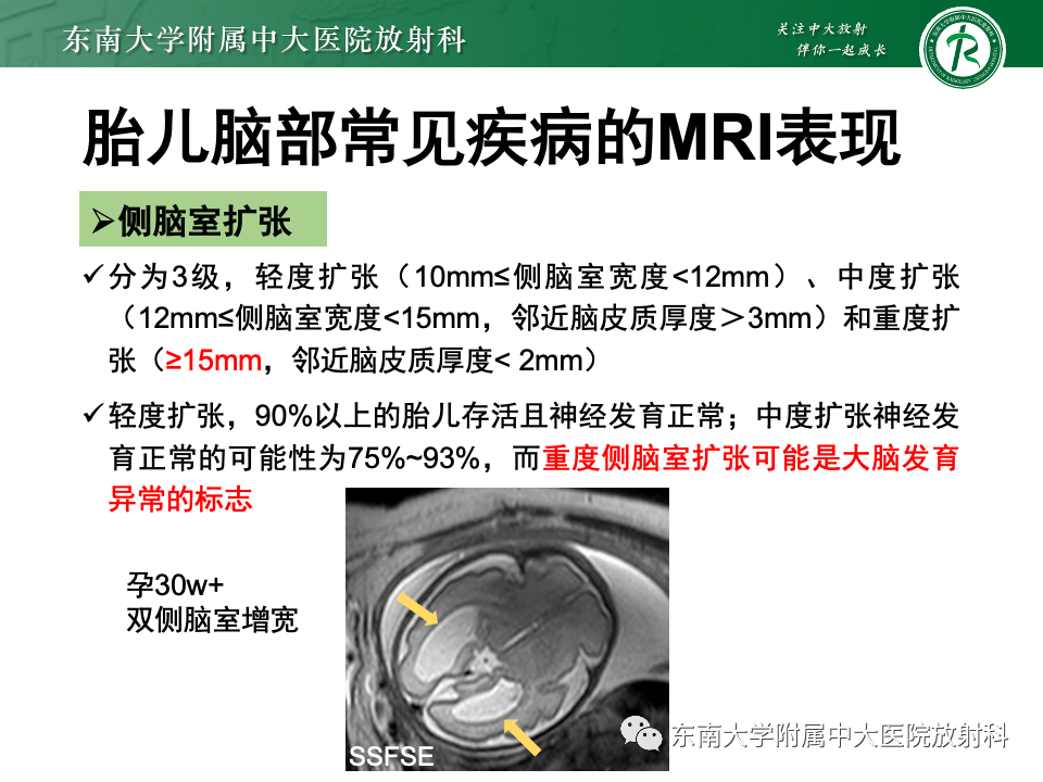 影像PPT - 【PPT】胎儿颅脑MRI技术及常见神经系统发育异常-50