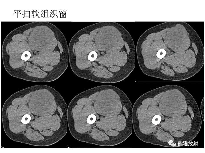 影像PPT - 【病例】软组织血管纤维瘤2例CT及MR影像-5