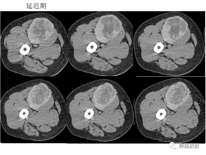 影像PPT - 【病例】软组织血管纤维瘤2例CT及MR影像-8
