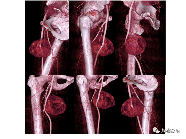 影像PPT - 【病例】软组织血管纤维瘤2例CT及MR影像-11
