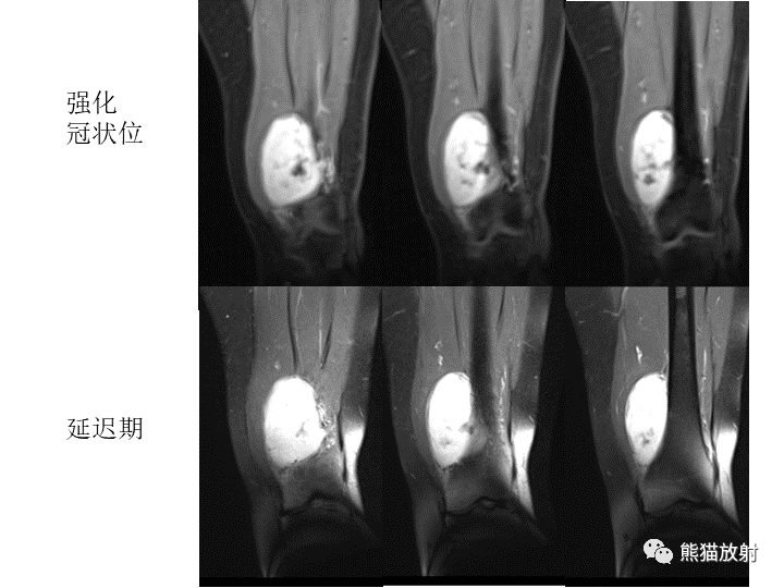 影像PPT - 【病例】软组织血管纤维瘤2例CT及MR影像-21