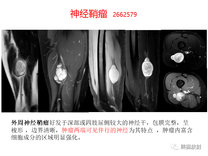 影像PPT - 【病例】软组织血管纤维瘤2例CT及MR影像-33