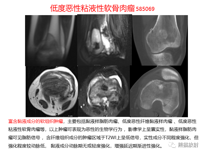影像PPT - 【病例】软组织血管纤维瘤2例CT及MR影像-34