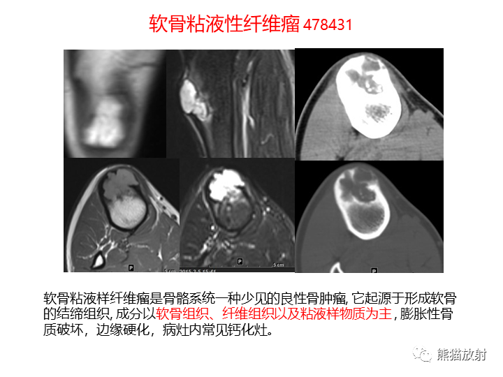 影像PPT - 【病例】软组织血管纤维瘤2例CT及MR影像-35