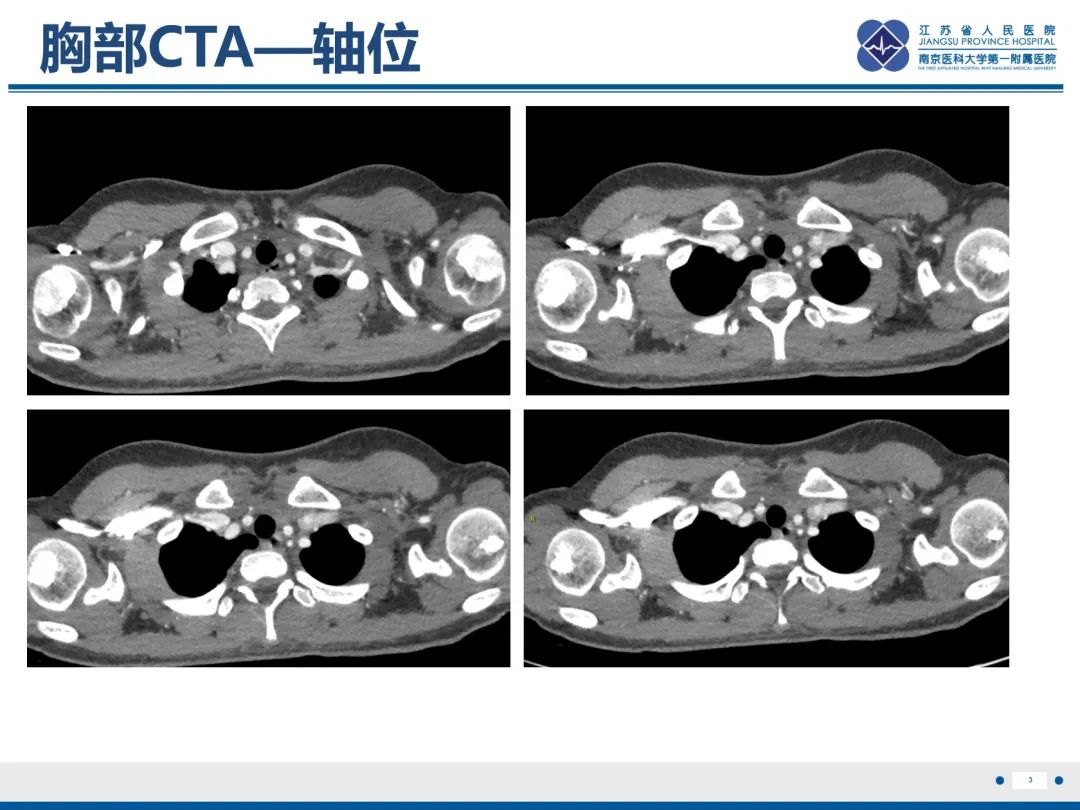 影像PPT - 【PPT】胸廓出口综合征-4