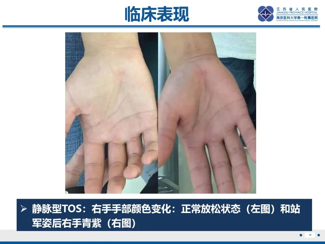 影像PPT - 【PPT】胸廓出口综合征-20