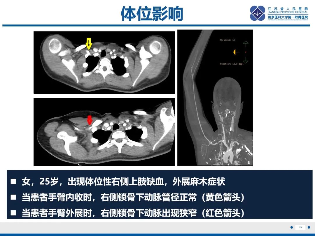 影像PPT - 【PPT】胸廓出口综合征-24
