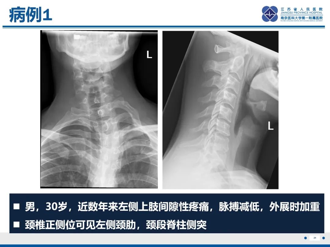 影像PPT - 【PPT】胸廓出口综合征-25