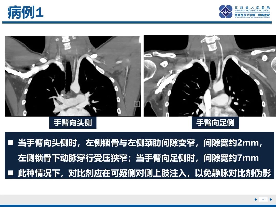 影像PPT - 【PPT】胸廓出口综合征-26