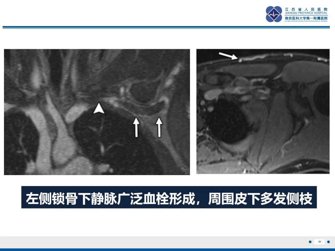 影像PPT - 【PPT】胸廓出口综合征-29