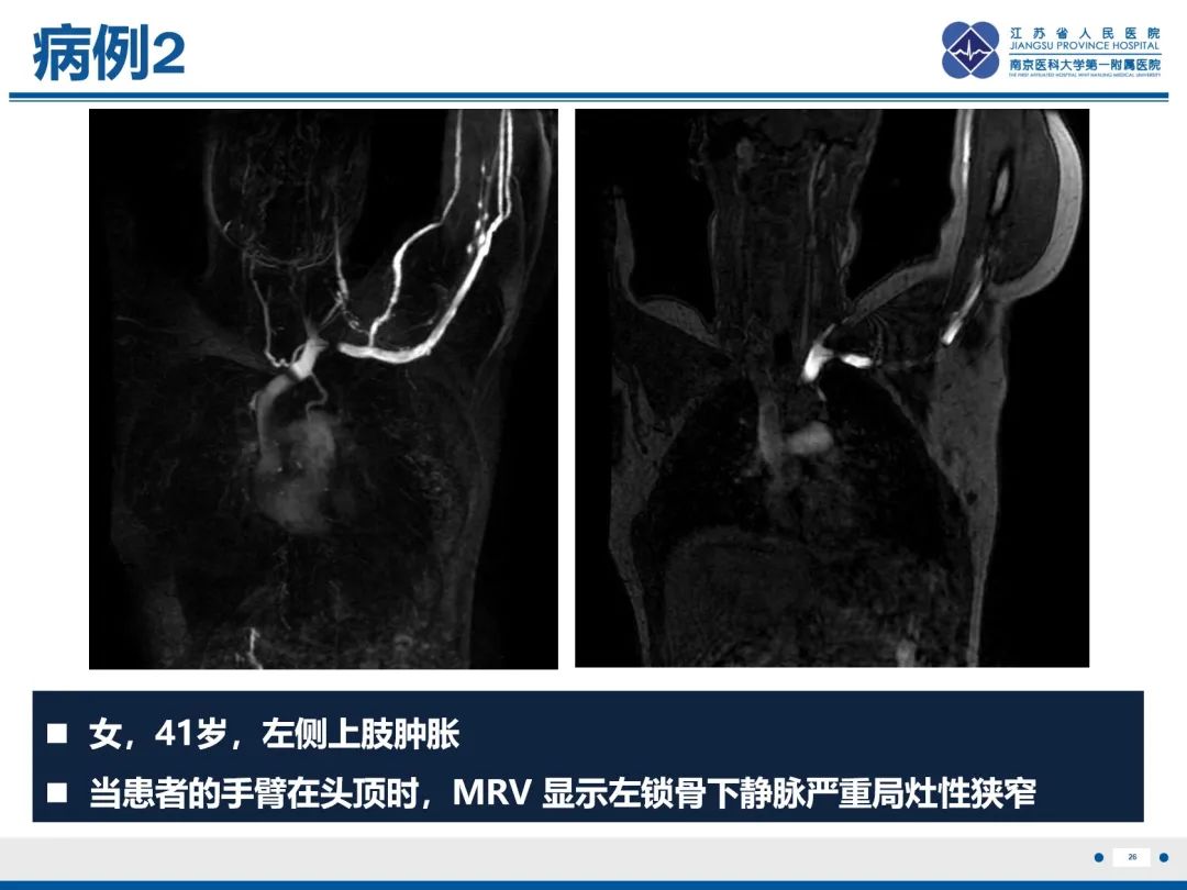 影像PPT - 【PPT】胸廓出口综合征-27