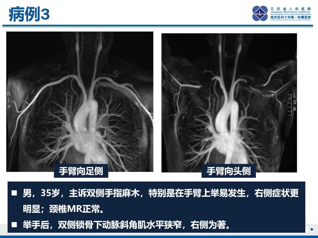 影像PPT - 【PPT】胸廓出口综合征-28