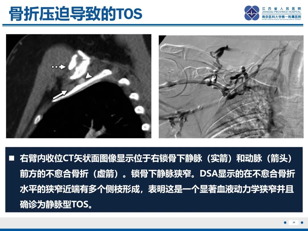 影像PPT - 【PPT】胸廓出口综合征-30