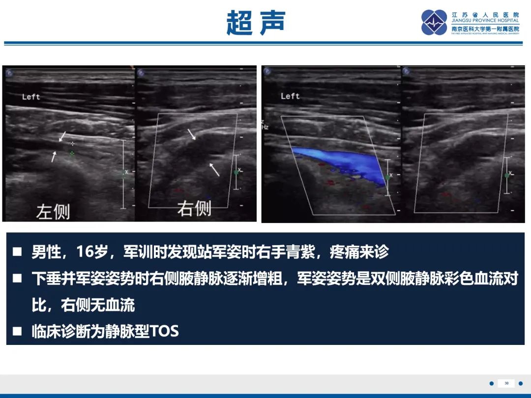 影像PPT - 【PPT】胸廓出口综合征-31