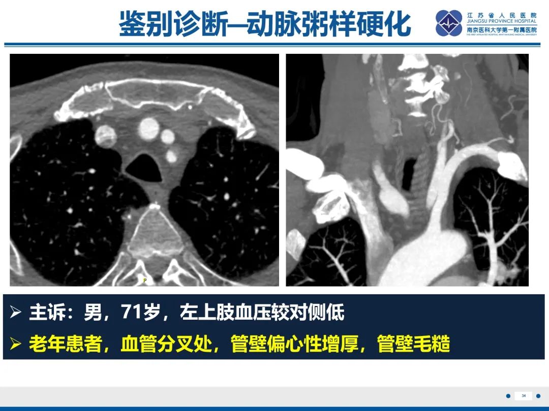 影像PPT - 【PPT】胸廓出口综合征-35