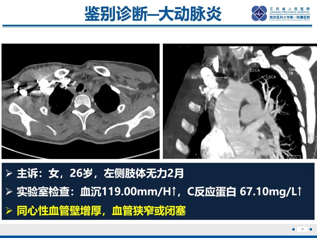 影像PPT - 【PPT】胸廓出口综合征-34
