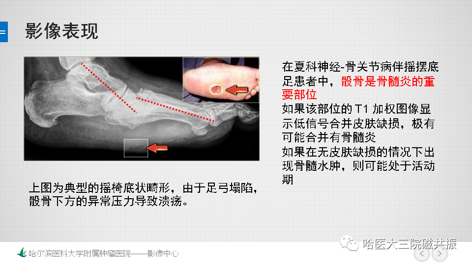 影像PPT - 【PPT】夏科足-23
