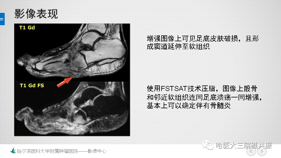 影像PPT - 【PPT】夏科足-25