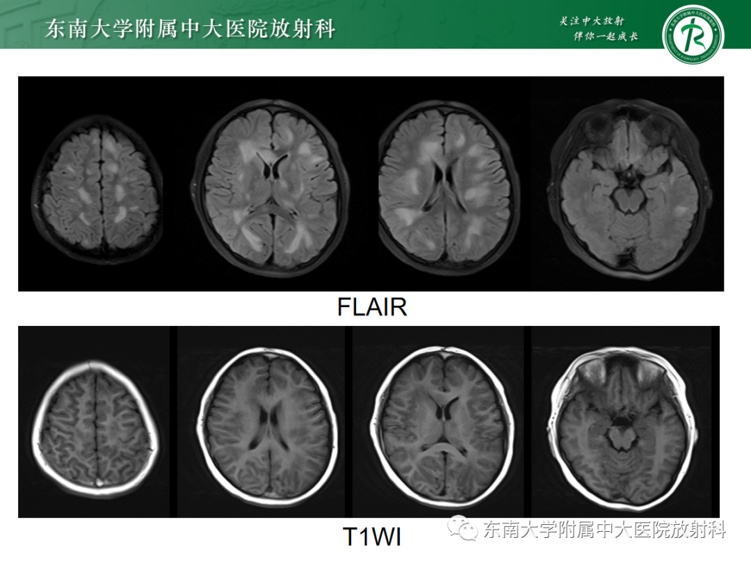 影像PPT - 【PPT】皮层下U形纤维受累常见病变-2