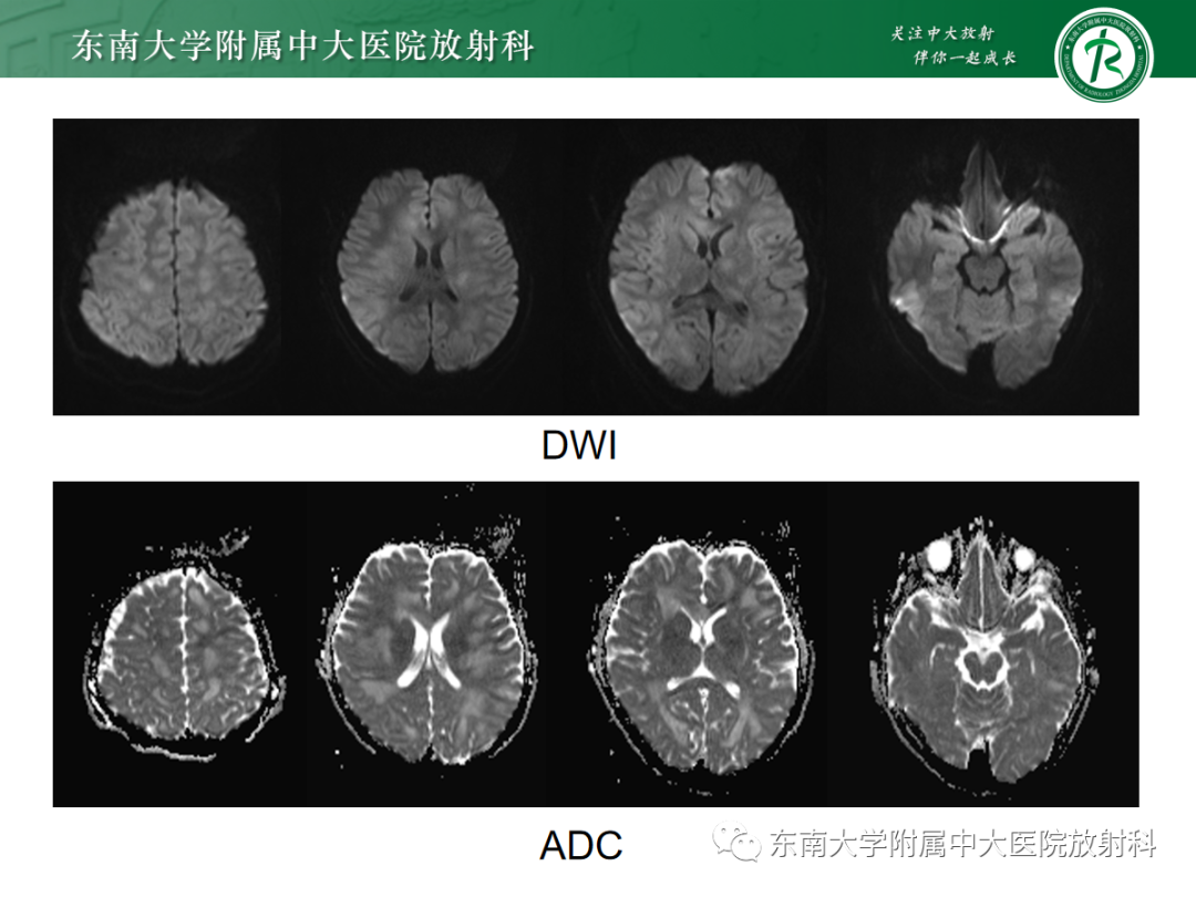 影像PPT - 【PPT】皮层下U形纤维受累常见病变-3