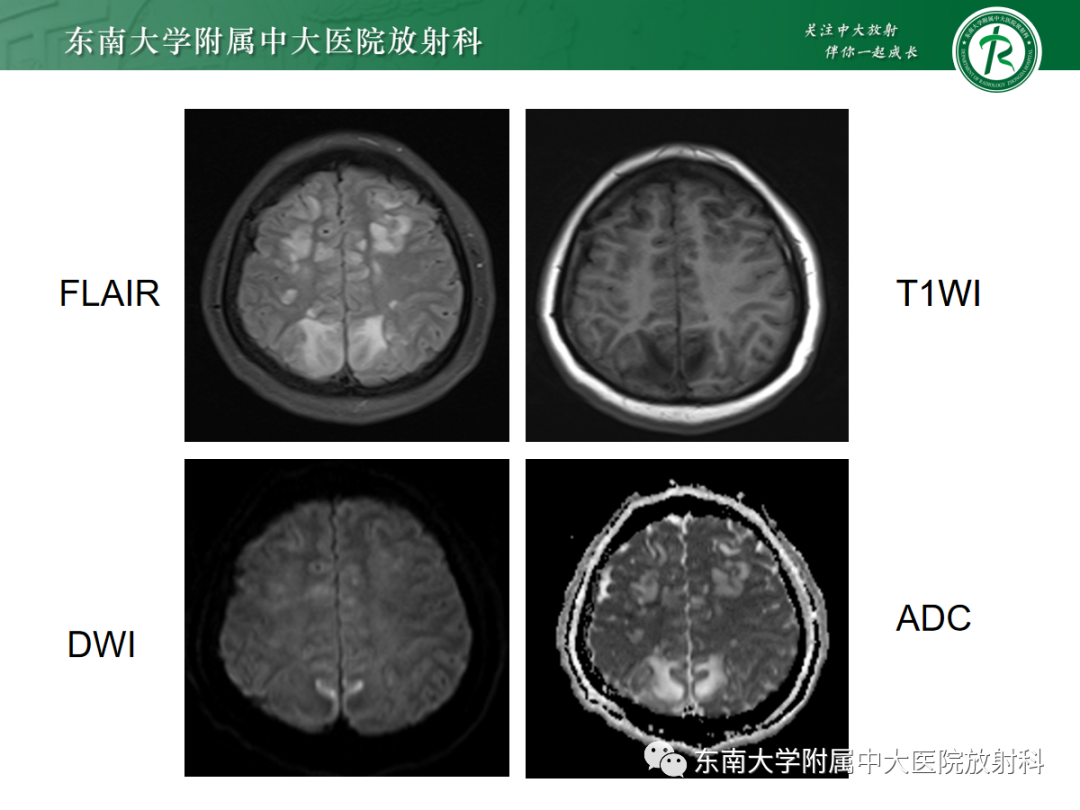 影像PPT - 【PPT】皮层下U形纤维受累常见病变-5