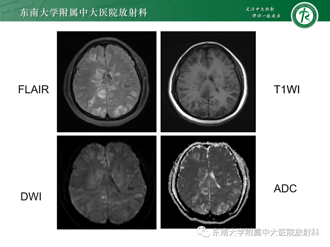 影像PPT - 【PPT】皮层下U形纤维受累常见病变-6