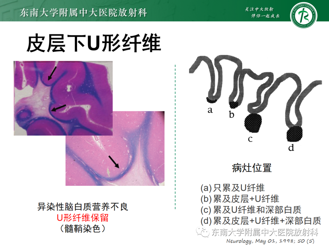 影像PPT - 【PPT】皮层下U形纤维受累常见病变-18