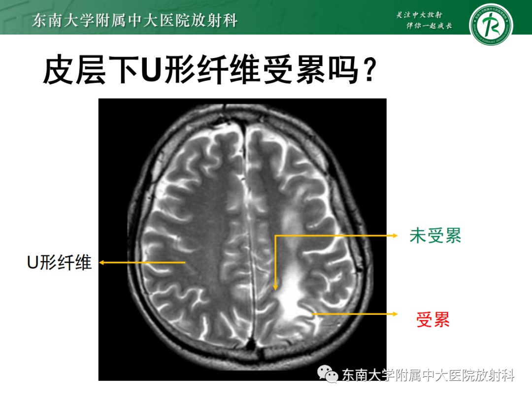 影像PPT - 【PPT】皮层下U形纤维受累常见病变-20