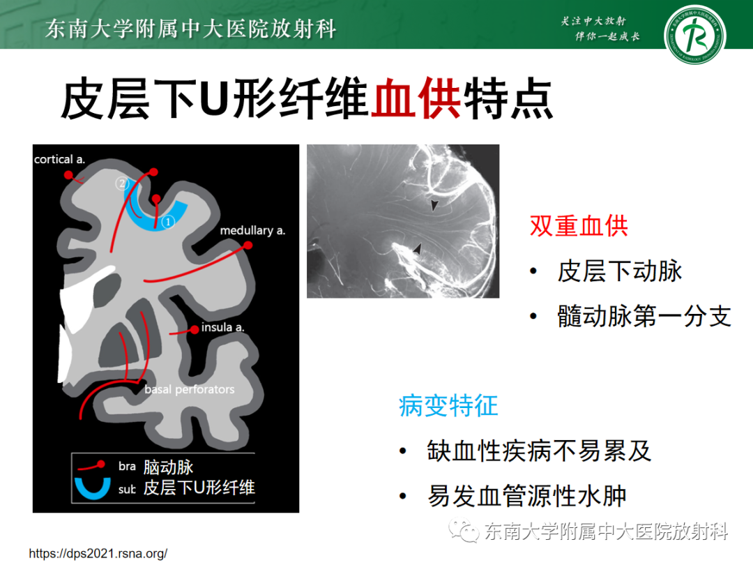 影像PPT - 【PPT】皮层下U形纤维受累常见病变-22