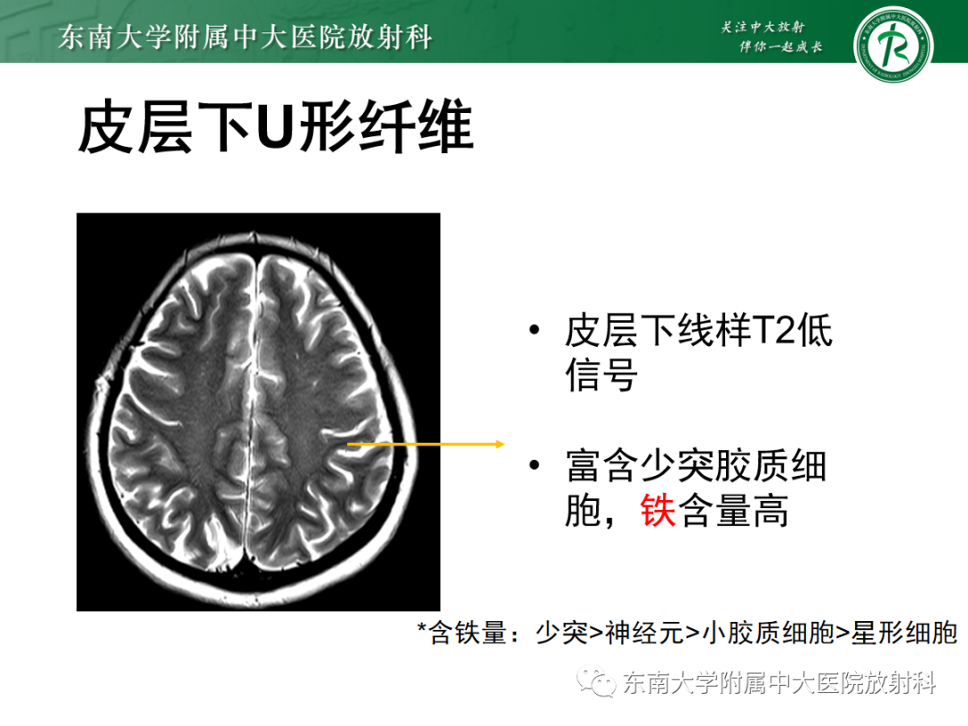 影像PPT - 【PPT】皮层下U形纤维受累常见病变-19