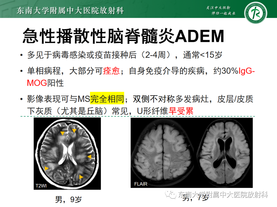 影像PPT - 【PPT】皮层下U形纤维受累常见病变-26
