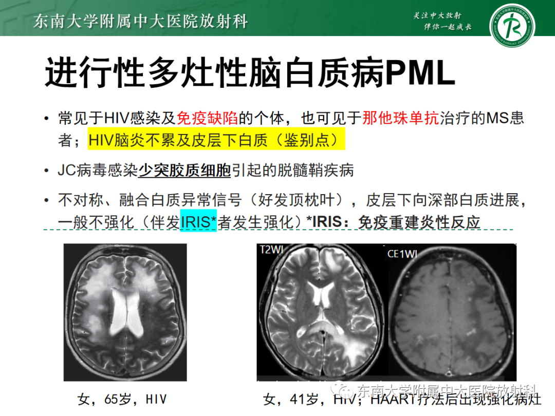 影像PPT - 【PPT】皮层下U形纤维受累常见病变-27