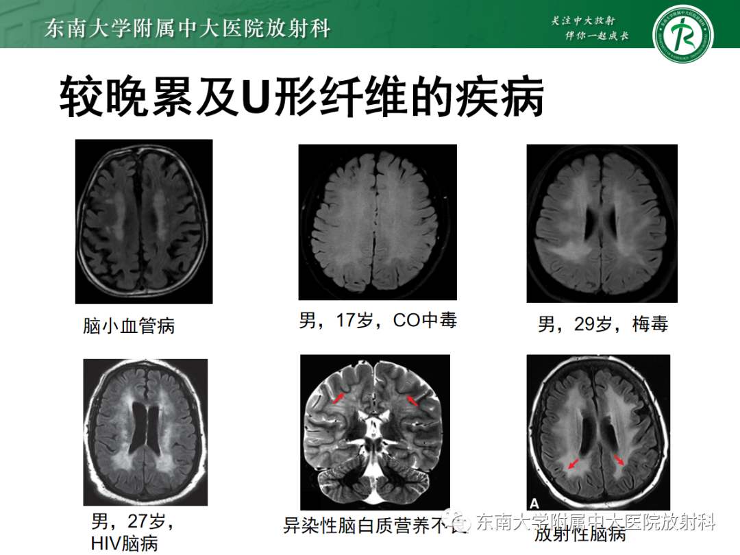 影像PPT - 【PPT】皮层下U形纤维受累常见病变-31