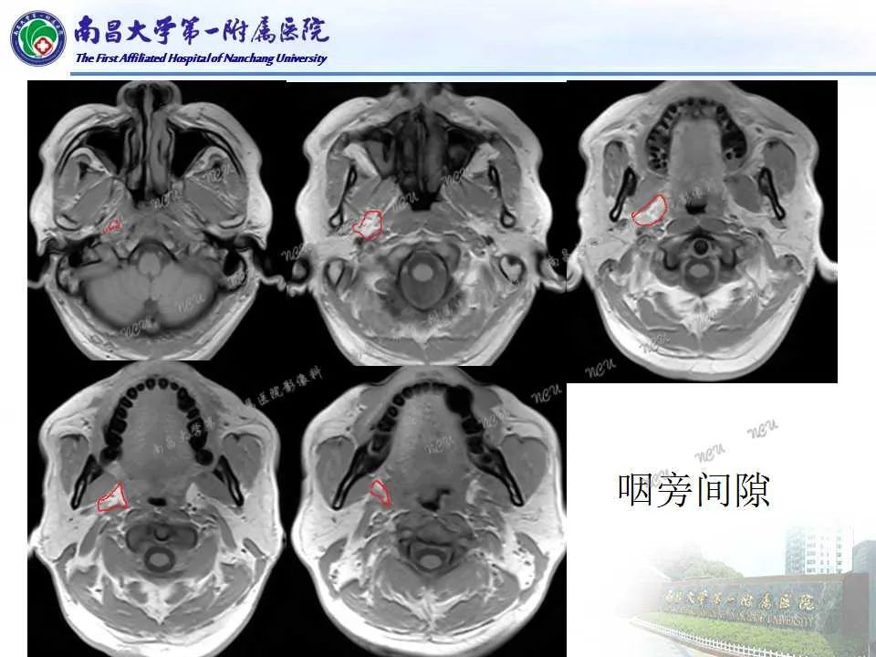 影像PPT - 【PPT】咽旁间隙——你别动-8