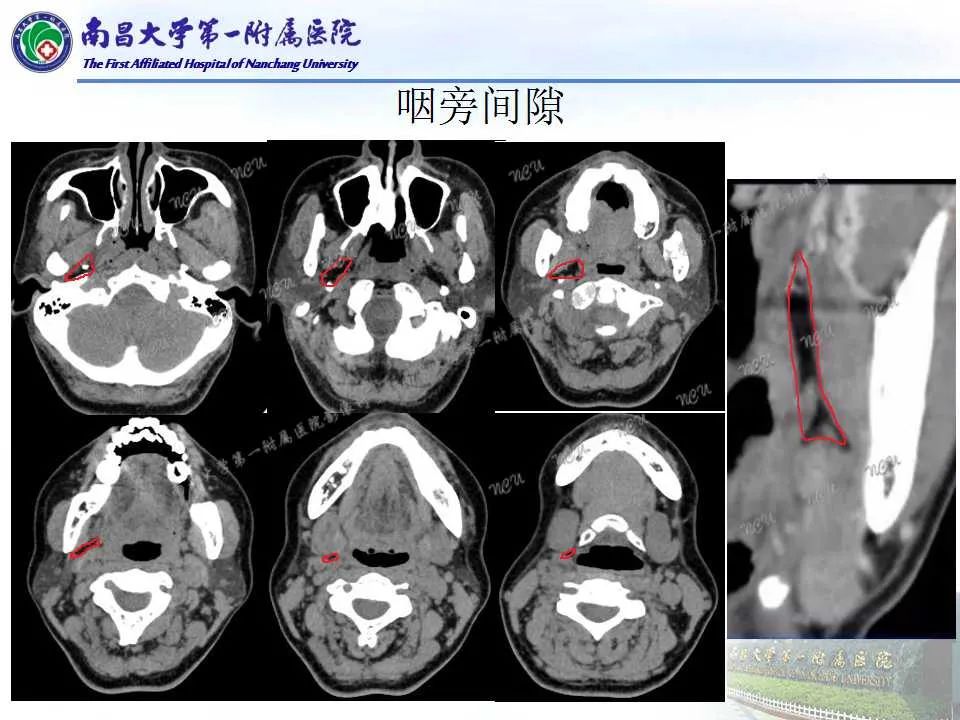 影像PPT - 【PPT】咽旁间隙——你别动-7