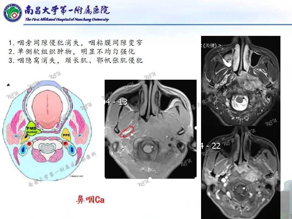 影像PPT - 【PPT】咽旁间隙——你别动-16