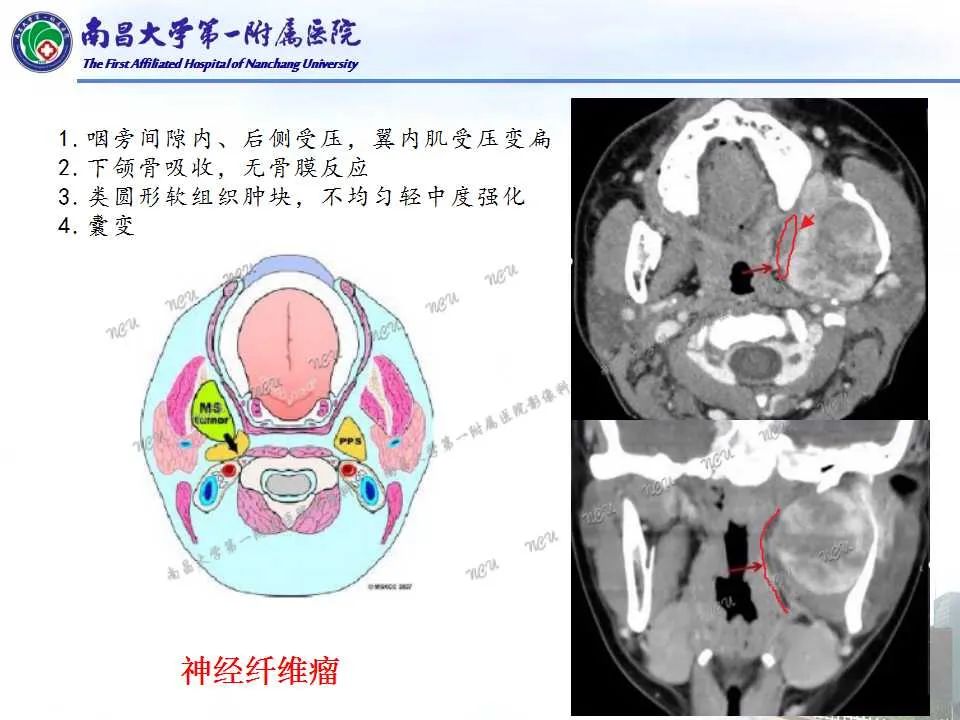 影像PPT - 【PPT】咽旁间隙——你别动-17
