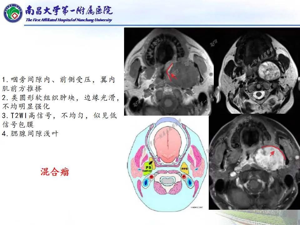 影像PPT - 【PPT】咽旁间隙——你别动-18